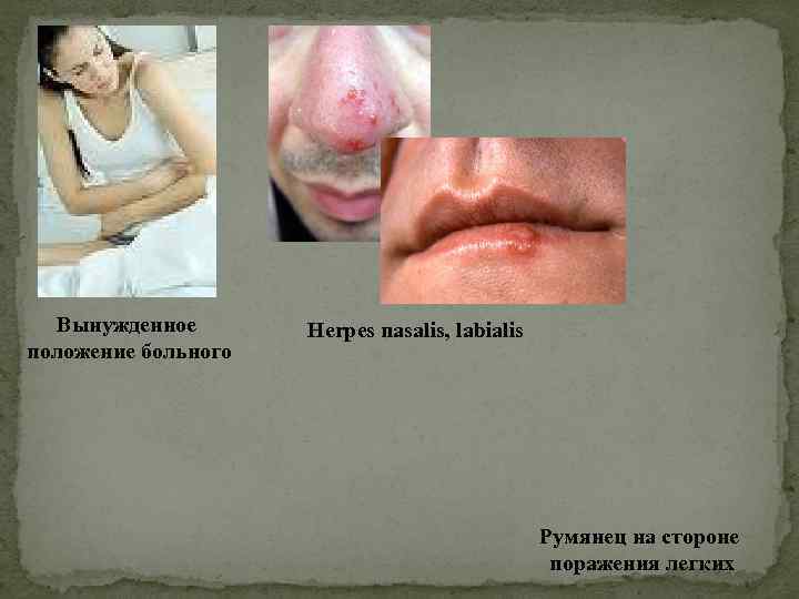 Вынужденное положение больного Herpes nasalis, labialis Румянец на стороне поражения легких 