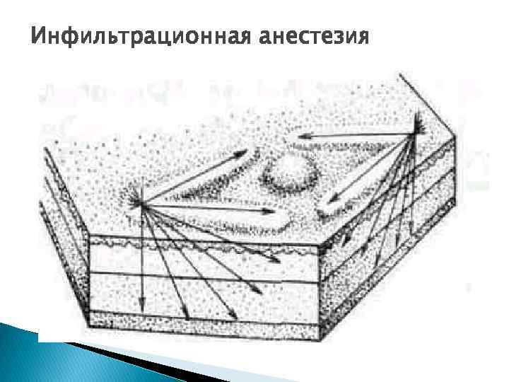 Инфильтрационная анестезия 