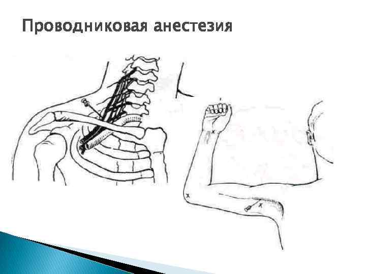 Проводниковая анестезия 