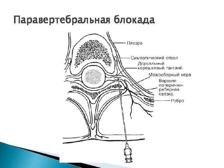 Паравертебральная блокада 