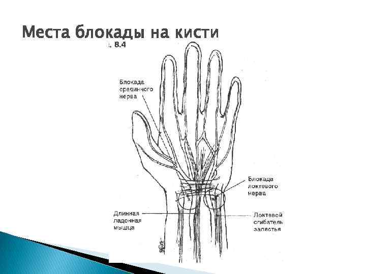 Места блокады на кисти 