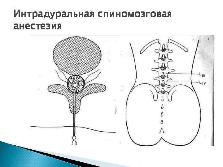 Интрадуральная спиномозговая анестезия 