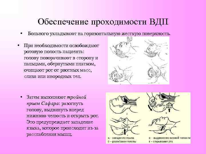Обеспечение проходимости ВДП • Больного укладывают на горизонтальную жесткую поверхность. • При необходимости освобождают