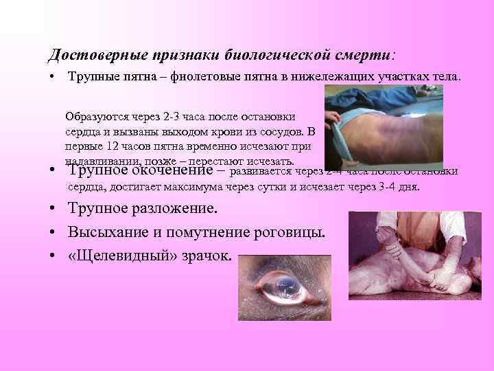 Достоверные признаки биологической смерти: • Трупные пятна – фиолетовые пятна в нижележащих участках тела.