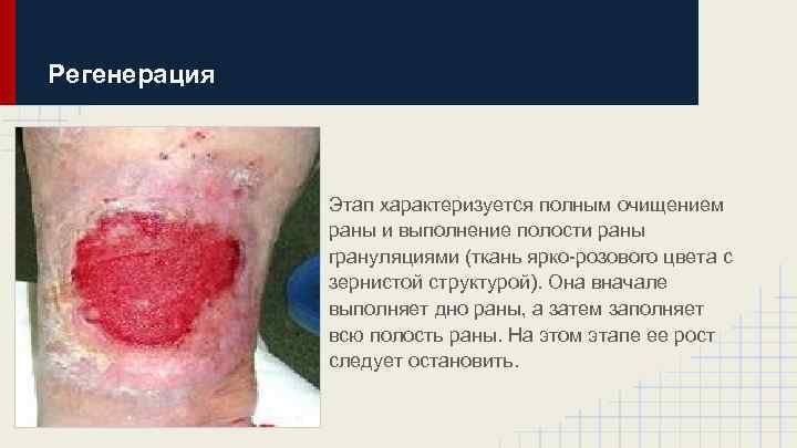 Регенерация Этап характеризуется полным очищением раны и выполнение полости раны грануляциями (ткань ярко-розового цвета