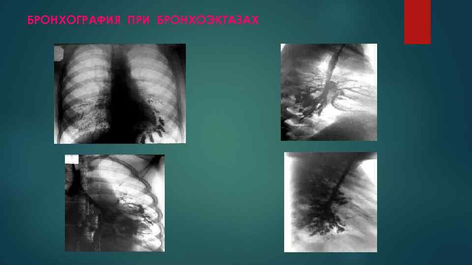 БРОНХОГРАФИЯ ПРИ БРОНХОЭКТАЗАХ 