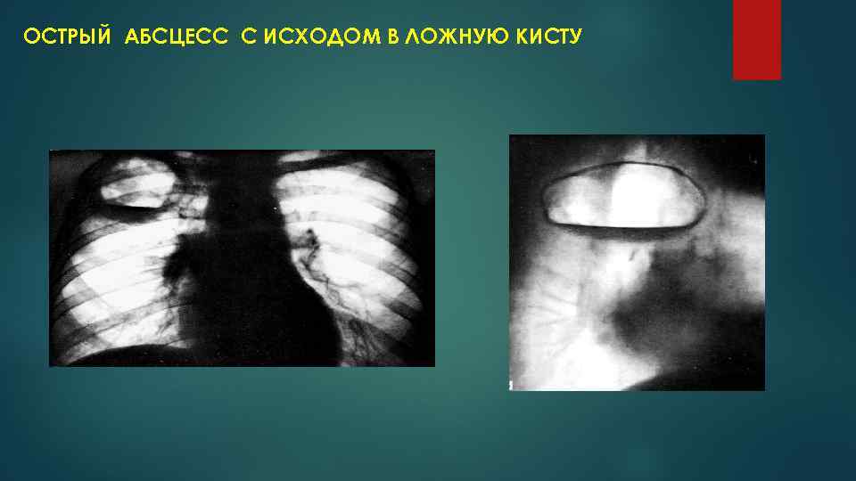 ОСТРЫЙ АБСЦЕСС С ИСХОДОМ В ЛОЖНУЮ КИСТУ 