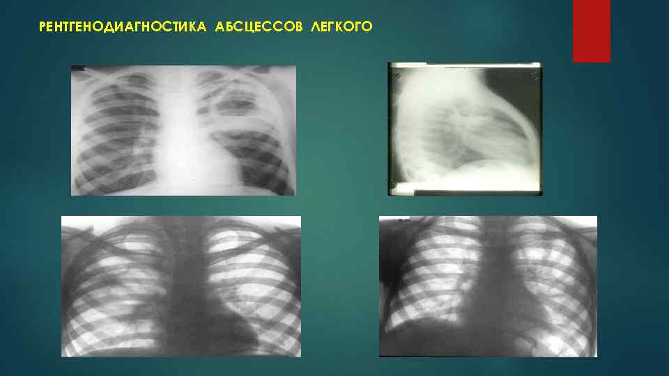 РЕНТГЕНОДИАГНОСТИКА АБСЦЕССОВ ЛЕГКОГО 