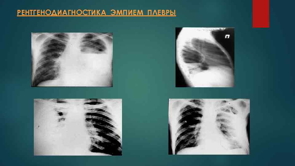 Пиоторакс это. Рентген при эмпиеме плевры. Туберкулезная эмпиема рентген. Эмпиема плевры рентген признаки.