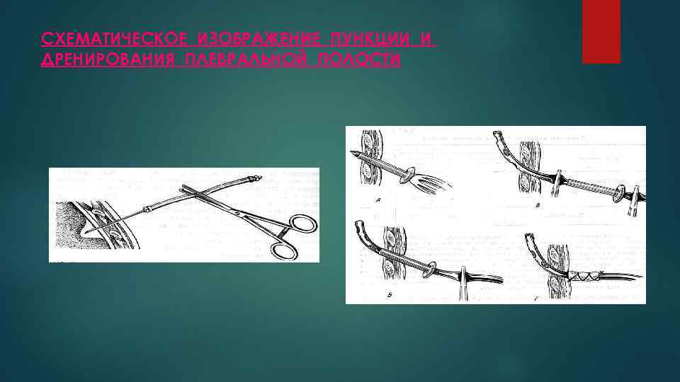 СХЕМАТИЧЕСКОЕ ИЗОБРАЖЕНИЕ ПУНКЦИИ И ДРЕНИРОВАНИЯ ПЛЕВРАЛЬНОЙ ПОЛОСТИ 