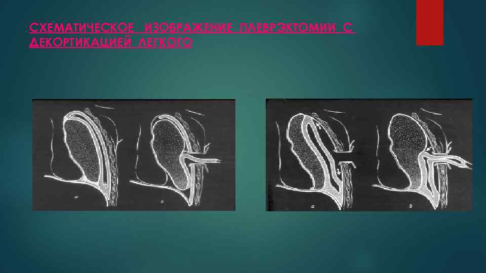 Плеврэктомия. Декортикация и плеврэктомия. Плеврэктомия и декортикация легкого техника.