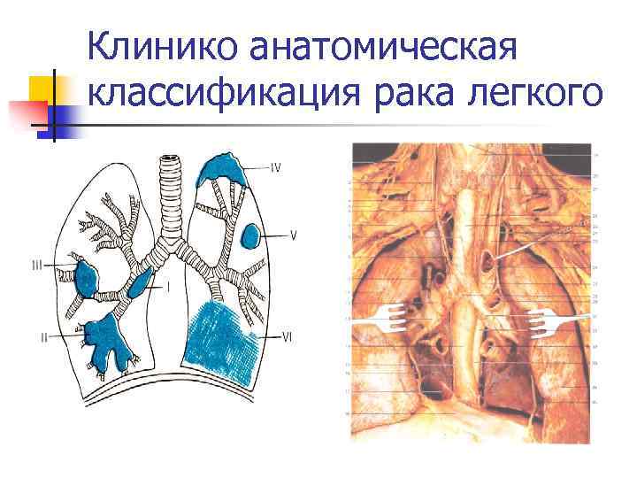 Клинико анатомическая классификация рака легкого 