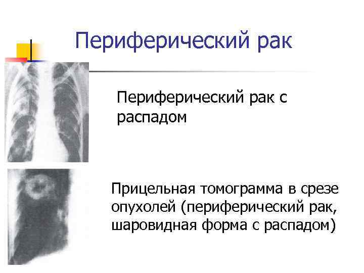 Периферический рак с распадом Прицельная томограмма в срезе опухолей (периферический рак, шаровидная форма с