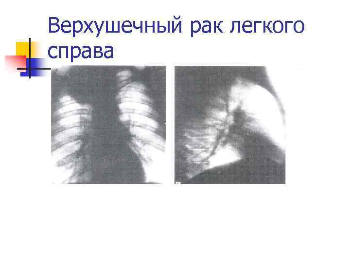 Верхушечный рак легкого справа 