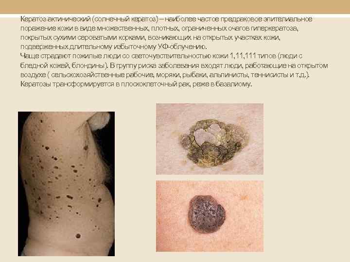 Кератоз актинический (солнечный кератоз) – наиболее частое предраковое эпителиальное поражение кожи в виде множественных,