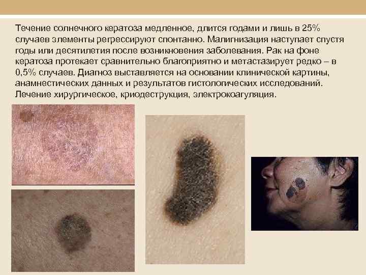 Течение солнечного кератоза медленное, длится годами и лишь в 25% случаев элементы регрессируют спонтанно.