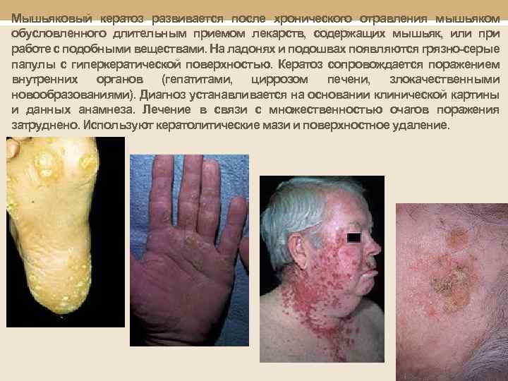 Мышьяковый кератоз развивается после хронического отравления мышьяком обусловленного длительным приемом лекарств, содержащих мышьяк, или