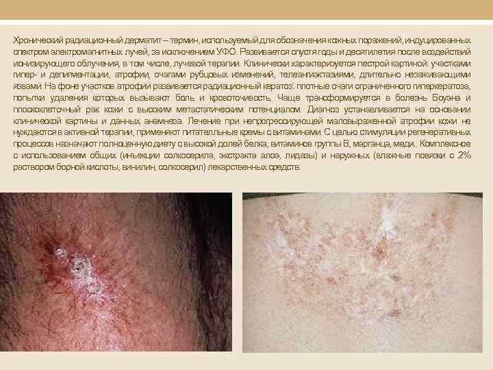 Хронический радиационный дерматит – термин, используемый для обозначения кожных поражений, индуцированных спектром электромагнитных лучей,