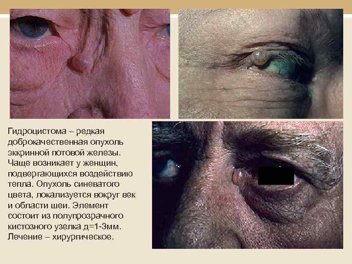  Гидроцистома – редкая доброкачественная опухоль эккринной потовой железы. Чаще возникает у женщин, подвергающихся