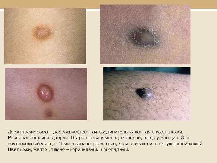 Дерматофиброма – доброкачественная соединительнотканная опухоль кожи, Располагающаяся в дерме. Встречается у молодых людей, чаще