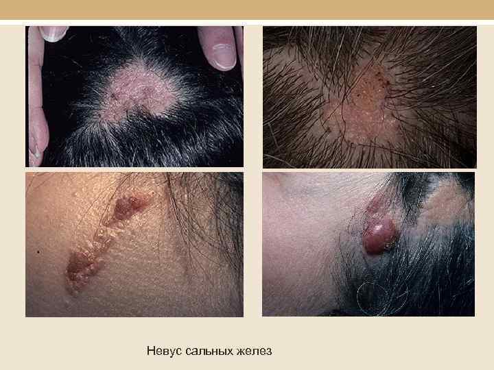 Невус сальных желез 