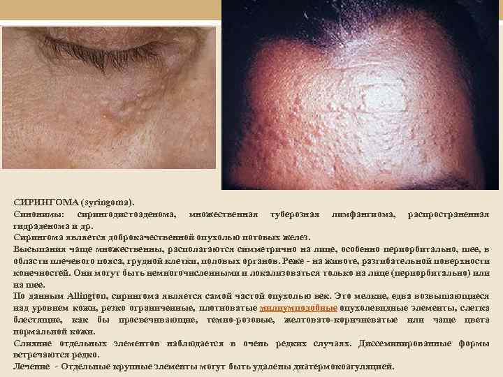СИРИНГОМА (syringoma). Синонимы: сирингодистоаденома, множественная туберозная лимфангиома, распространенная гидраденома и др. Сирингома является доброкачественной