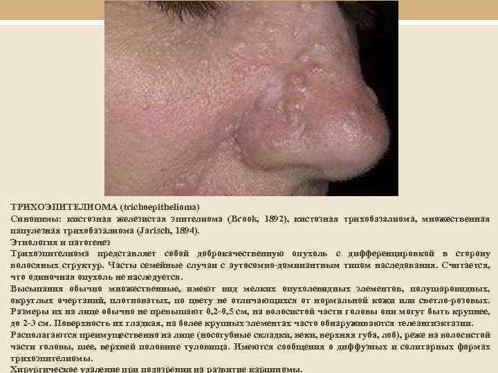 ТРИХОЭПИТЕЛИОМА (trichoepithelioma) Синонимы: кистозная железистая эпителиома (Brook, 1892), кистозная трихобазалиома, множественная папулезная трихобазалиома (Jarisch,