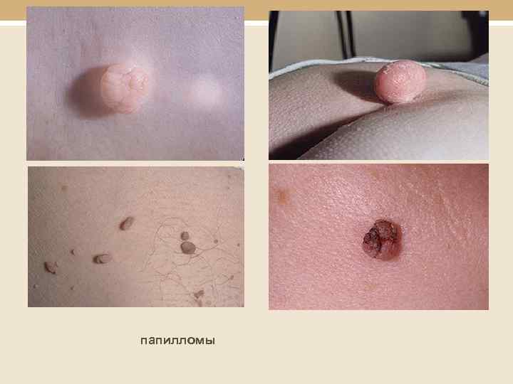 папилломы 
