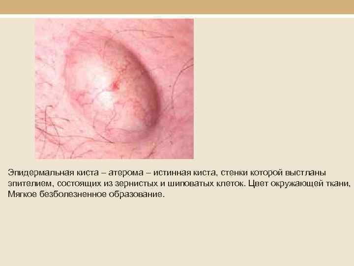 Эпидермальная киста – атерома – истинная киста, стенки которой выстланы эпителием, состоящих из зернистых