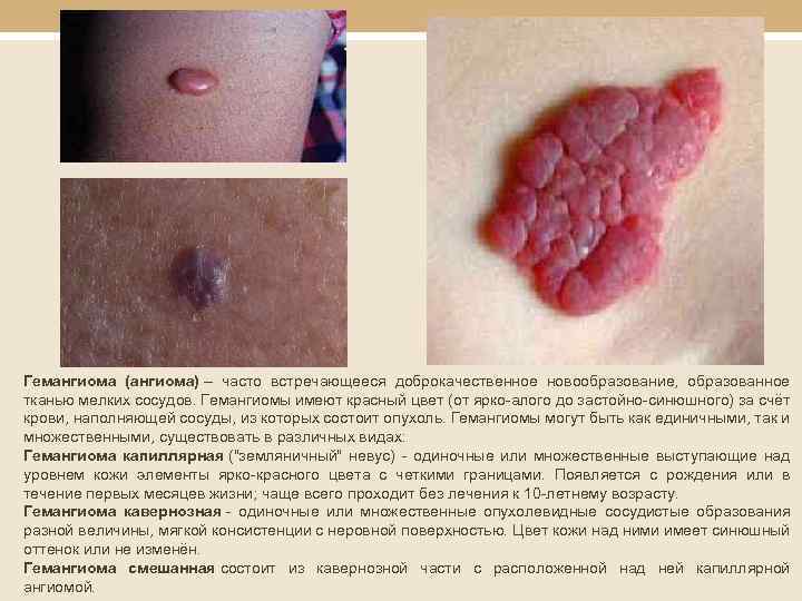 Гемангиома (ангиома) – часто встречающееся доброкачественное новообразование, образованное тканью мелких сосудов. Гемангиомы имеют красный