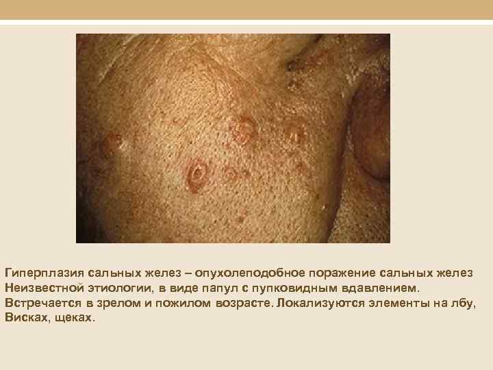Гиперплазия сальных желез – опухолеподобное поражение сальных желез Неизвестной этиологии, в виде папул с