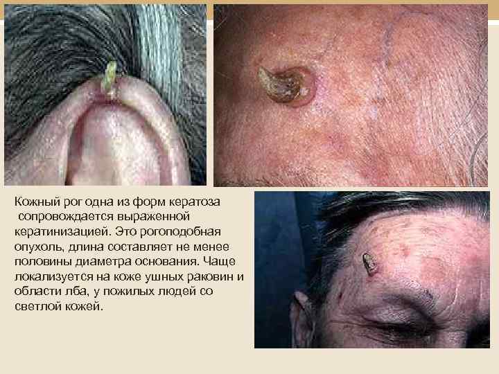  Кожный рог одна из форм кератоза сопровождается выраженной кератинизацией. Это рогоподобная опухоль, длина