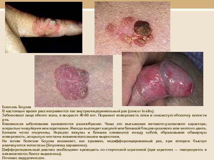  Болезнь Боуэна В настоящее время рассматривается как внутриэпидермиальный рак (cancer in situ). Заболевают