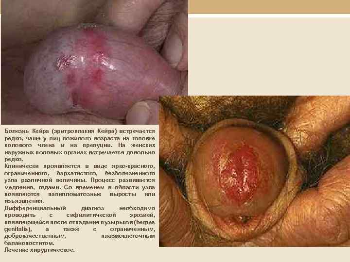  Болезнь Кейра (эритроплакия Кейра) встречается редко, чаще у лиц пожилого возраста на головке