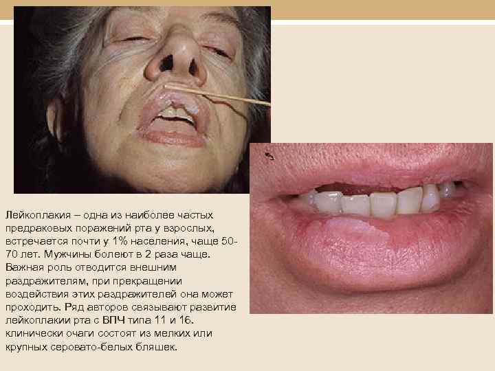 Лейкоплакия – одна из наиболее частых предраковых поражений рта у взрослых, встречается почти у