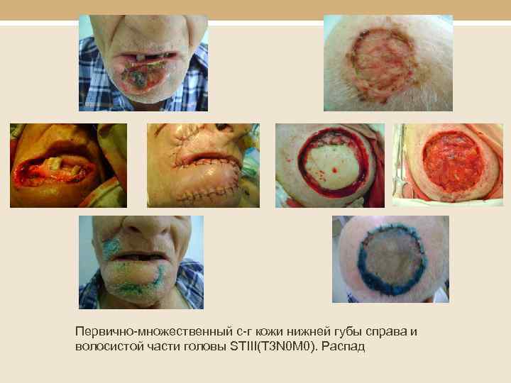 Первично-множественный с-г кожи нижней губы справа и волосистой части головы STIII(T 3 N 0