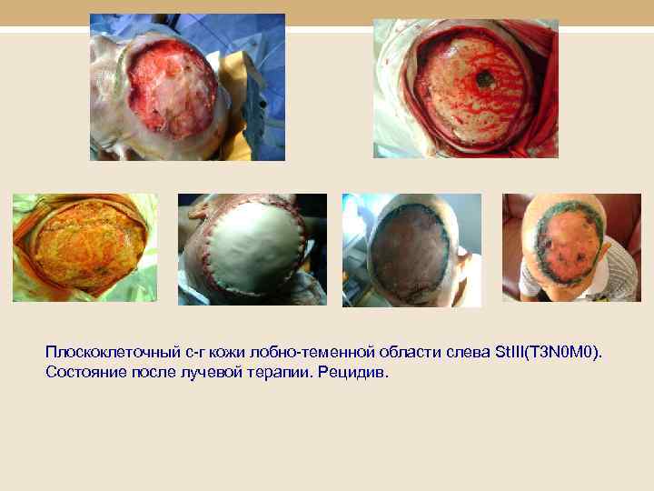 Плоскоклеточный с-г кожи лобно-теменной области слева St. III(T 3 N 0 M 0). Состояние