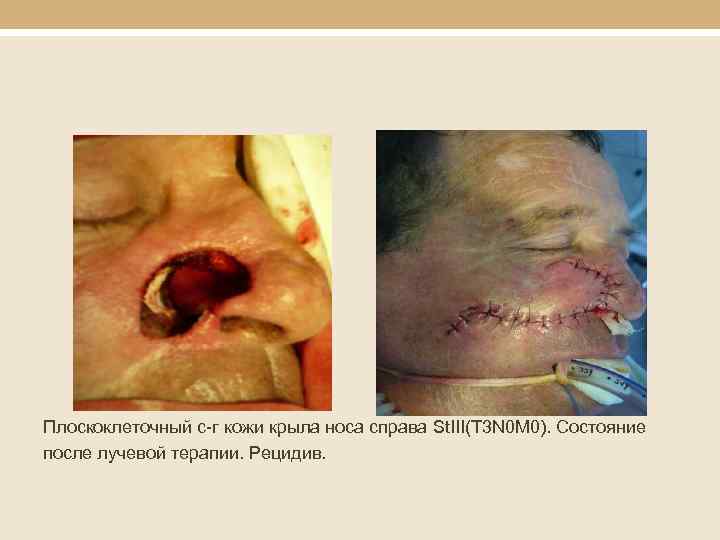 Плоскоклеточный с-г кожи крыла носа справа St. III(T 3 N 0 M 0). Состояние