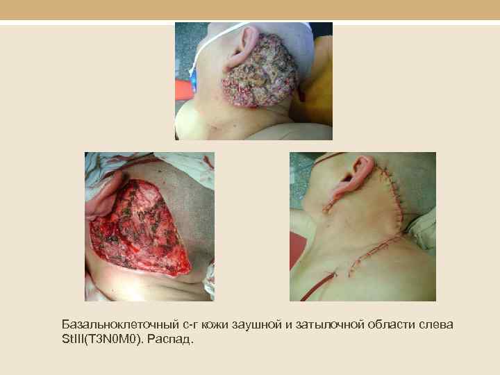 Базальноклеточный с-г кожи заушной и затылочной области слева St. III(T 3 N 0 M