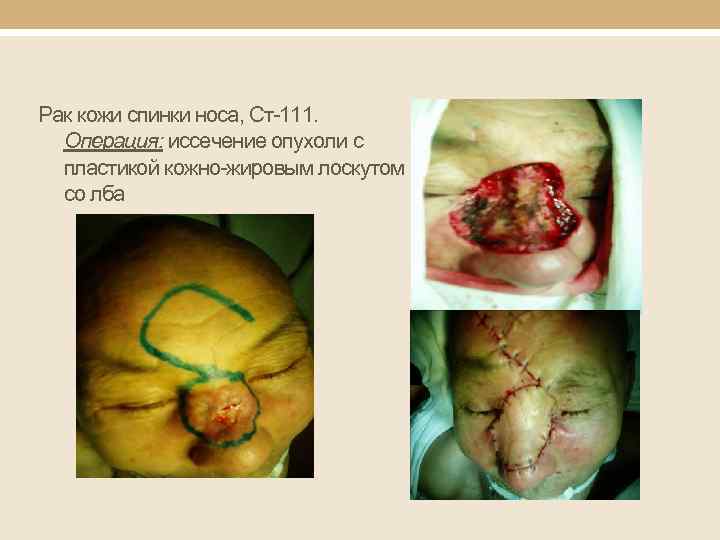 Рак кожи спинки носа, Ст-111. Операция: иссечение опухоли с пластикой кожно-жировым лоскутом со лба