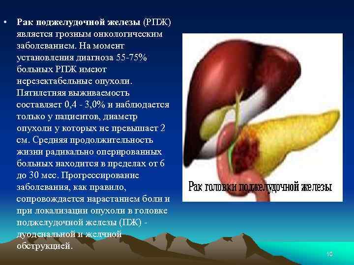  • Рак поджелудочной железы (РПЖ) является грозным онкологическим заболеванием. На момент установления диагноза