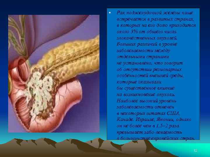  • Рак поджелудочной железы чаще встречается в развитых странах, в которых на его