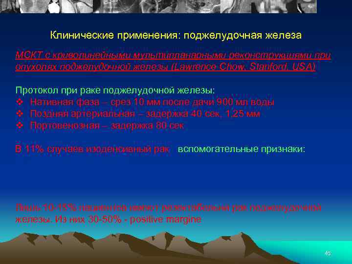 Клинические применения: поджелудочная железа МСКТ с криволинейными мультипланарными реконструкциями при опухолях поджелудочной железы (Lawrence
