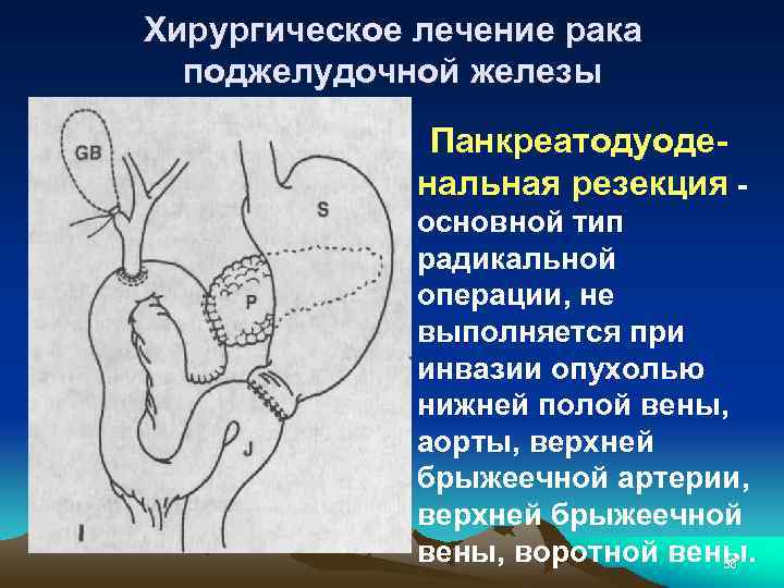 Хирургическое лечение рака поджелудочной железы Панкреатодуоде- нальная резекция - основной тип радикальной операции, не