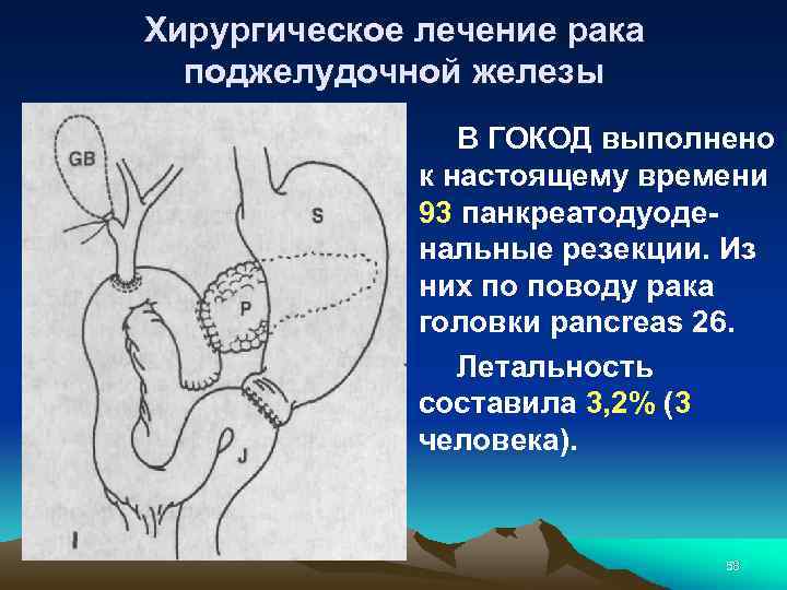 Хирургическое лечение рака поджелудочной железы В ГОКОД выполнено к настоящему времени 93 панкреатодуоденальные резекции.