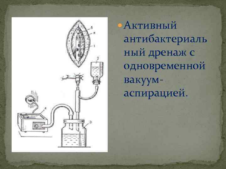  Активный антибактериаль ный дренаж с одновременной вакуумаспирацией. 