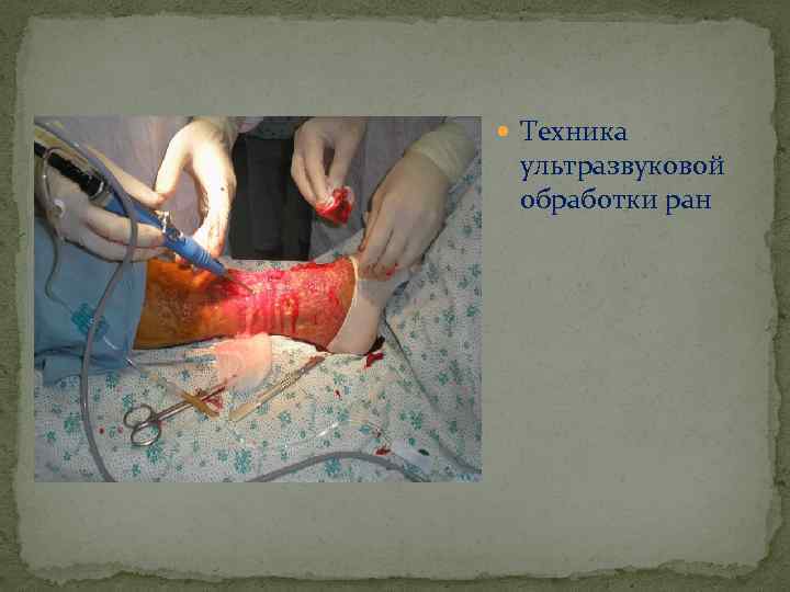  Техника ультразвуковой обработки ран 