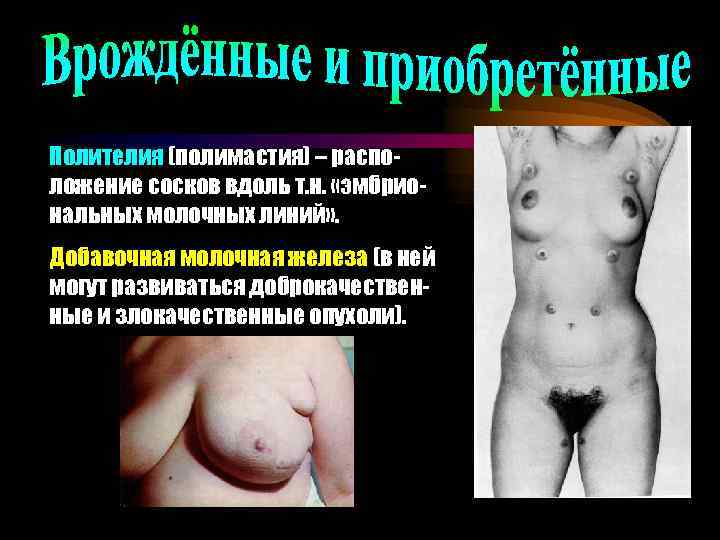 Полителия (полимастия) – расположение сосков вдоль т. н. «эмбриональных молочных линий» . Добавочная молочная