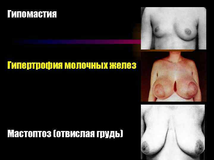 Гипомастия Гипертрофия молочных желез Мастоптоз (отвислая грудь) 