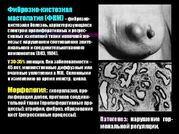 Фиброзно-кистозная мастопатия (ФКМ) – фиброзно- кистозная болезнь, характеризующаяся спектром пролиферативных и регрессивных изменений ткани
